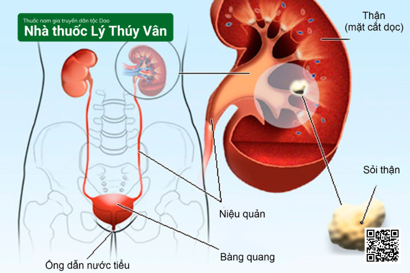 Điều Trị Sỏi Thận Hiệu Quả Không Mổ Bằng Thuốc Đông Y