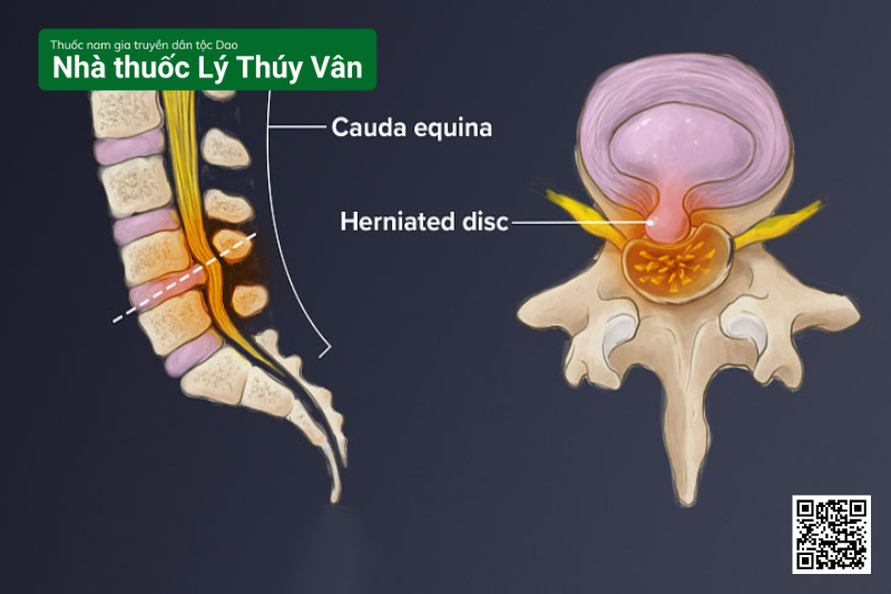 Biến Chứng Nguy Hiểm Của Bệnh Thoát Vị Đĩa Đệm Cột Sống