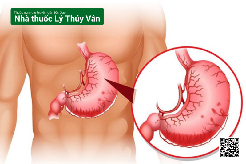 Viêm Dạ Dày Mạn Tính Là Gì? Có Nguy Hiểm Không?